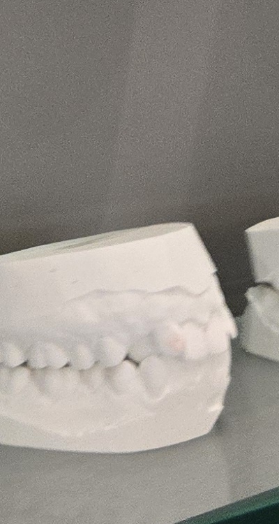 사랑니 주변 잇몸 통증 지금부터가 중요하니까 관련 이미지 37