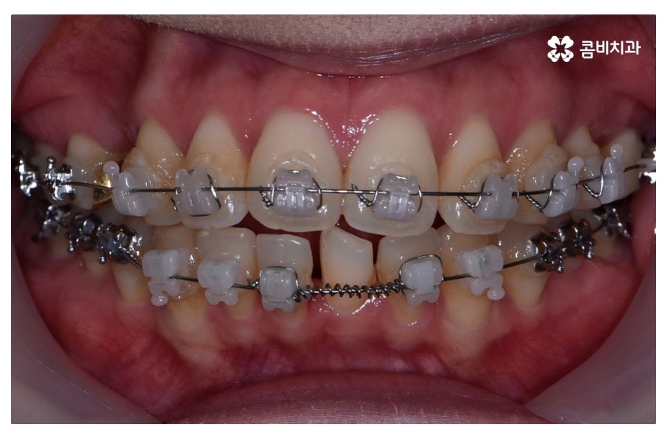 덧니교정 정확하게 알아보려면 관련 이미지 7