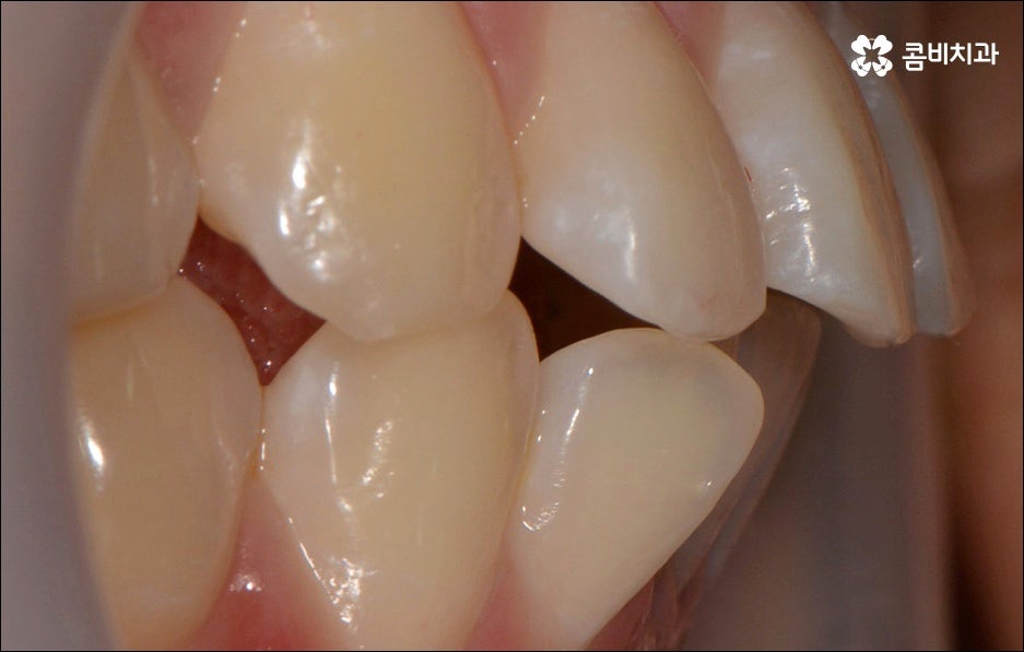 앞니 돌출 어떻게 고치나요? 관련 이미지 4