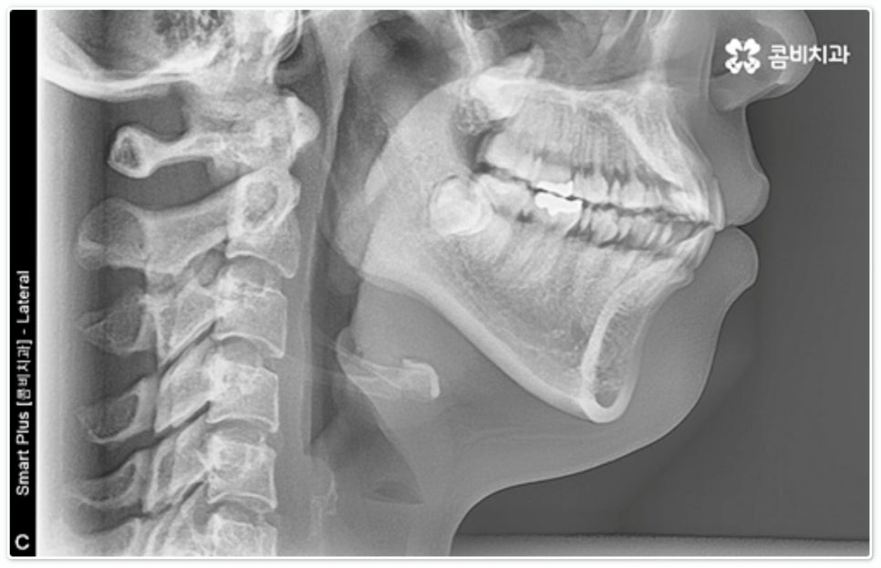 앞니부분교정 누구나 할수있나요? 관련 이미지 1