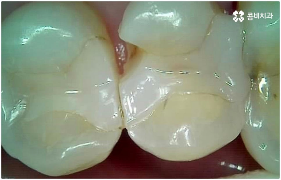 원데이임플란트 받고 싶으신가요? 관련 이미지 5