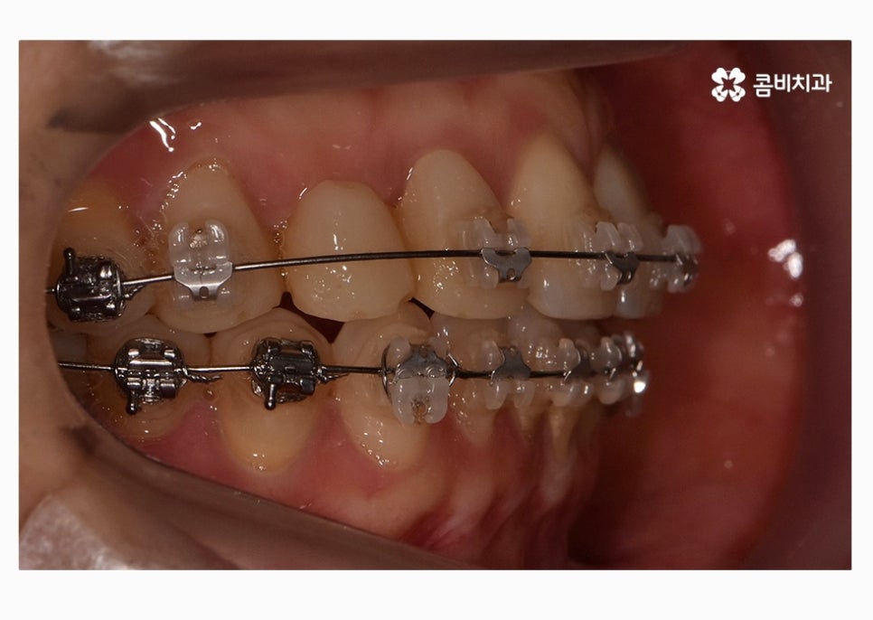 30대임플란트 향후 미래를 바라본다면 관련 이미지 6