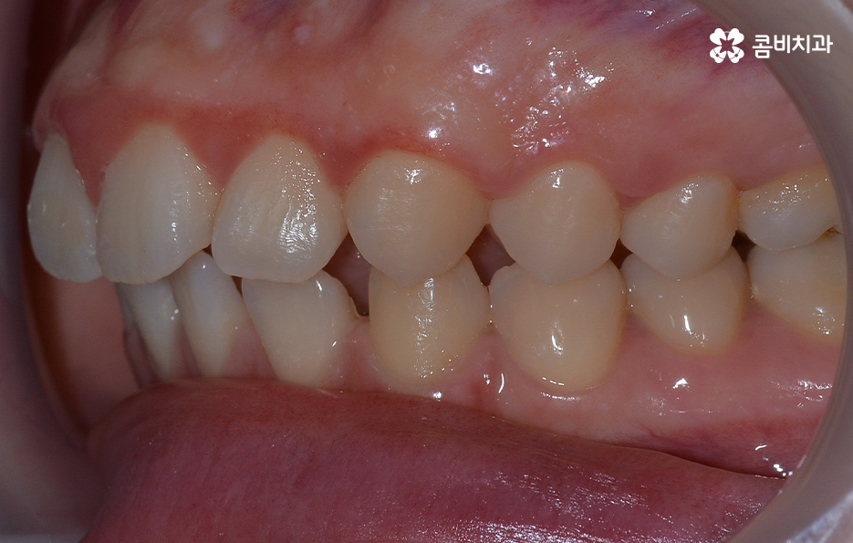 치아 벌어짐 교정으로 앞니 돌출까지 해결하기 관련 이미지 3