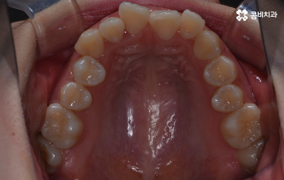 덧니 발치 교정 이런 경우에는 필요합니다 관련 이미지 3