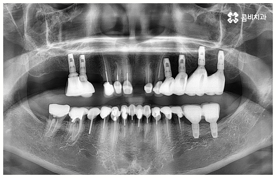 임플란트 치료기간 중점을 두어야 할것은 관련 이미지 5