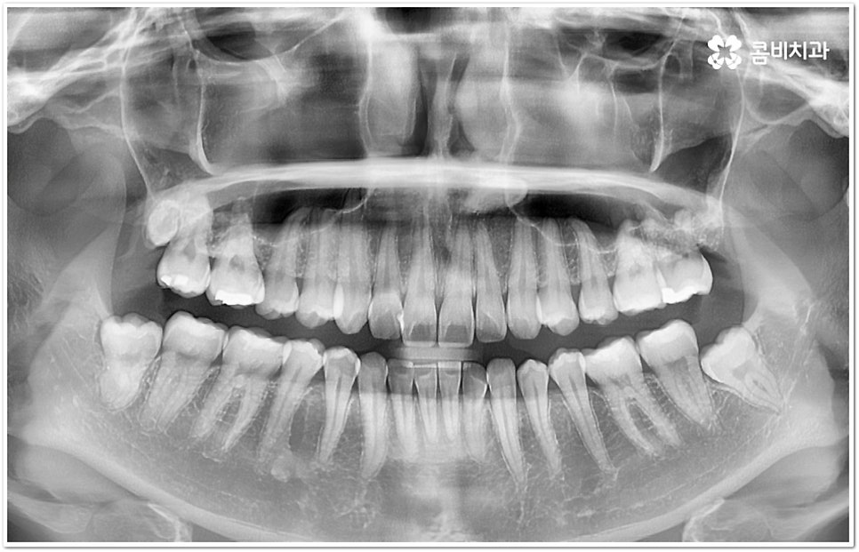덧니부분교정 시작하려면 관련 이미지 2