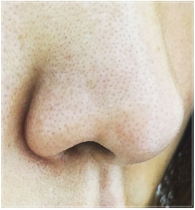 모공수축 쉽게하는방법 관련 이미지 2