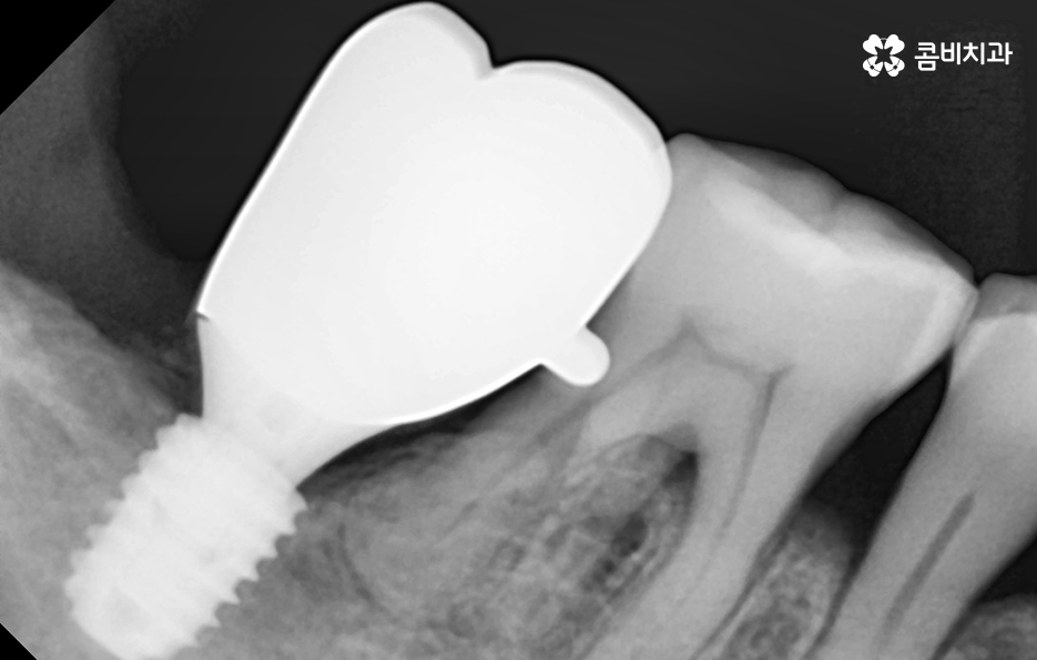 50대임플란트 각별하게 주의해야 하는 시기 관련 이미지 12