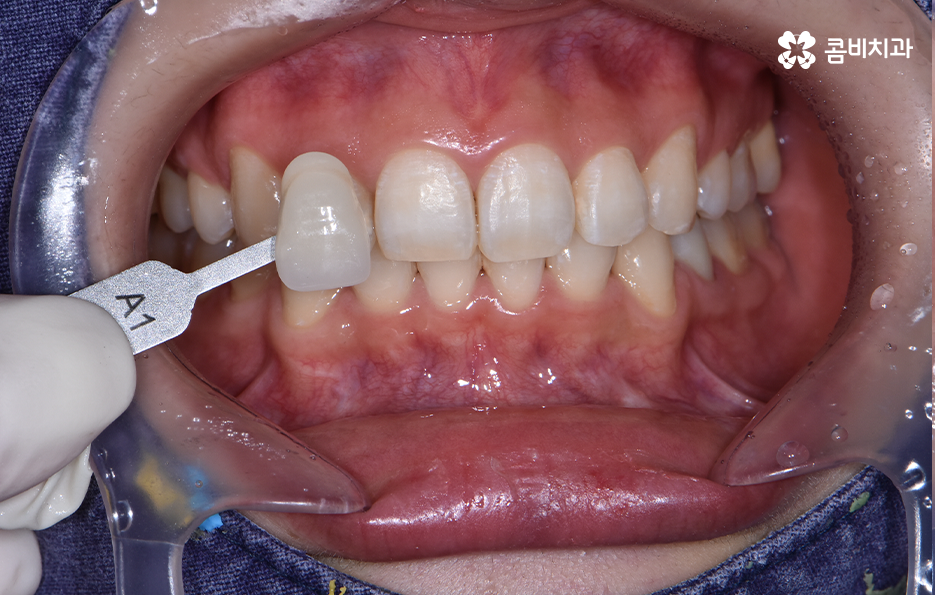 치과 치아미백 이렇게 시작해보세요 관련 이미지 2