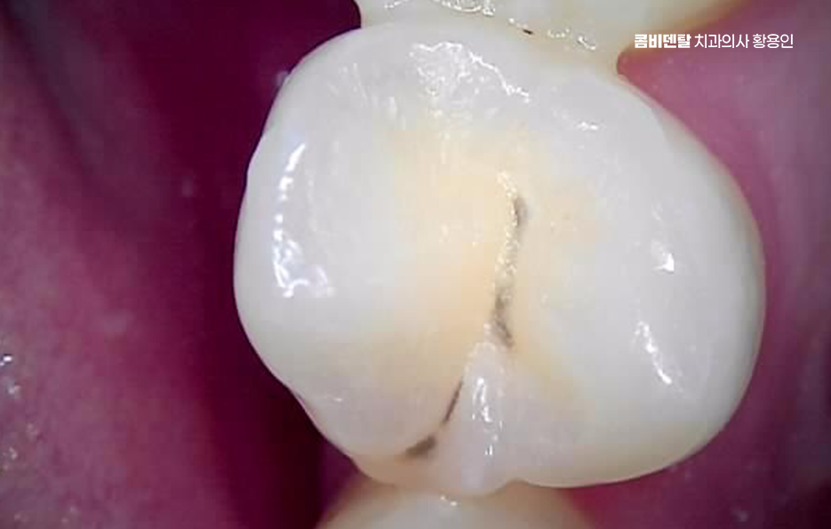 치아 시림 통증 갈수록 심해지다면 관련 이미지 6