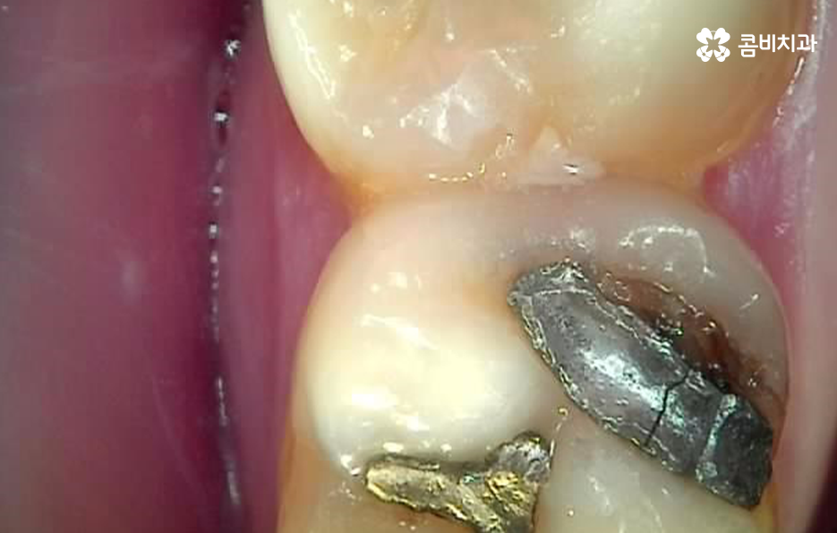 어금니 충치치료 깔끔하게 해결하려면 관련 이미지 3