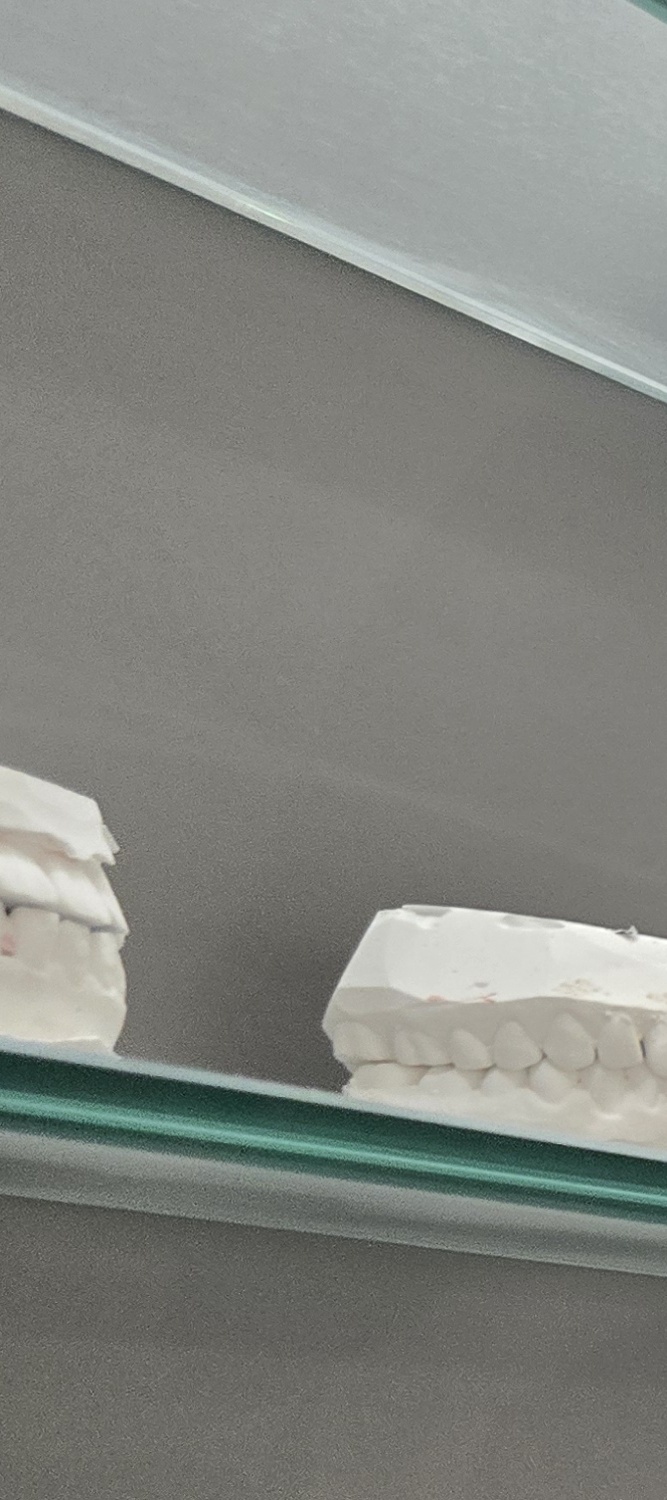 오래된 보철물 아말감 교체 어떠한 케이스일까 관련 이미지 11