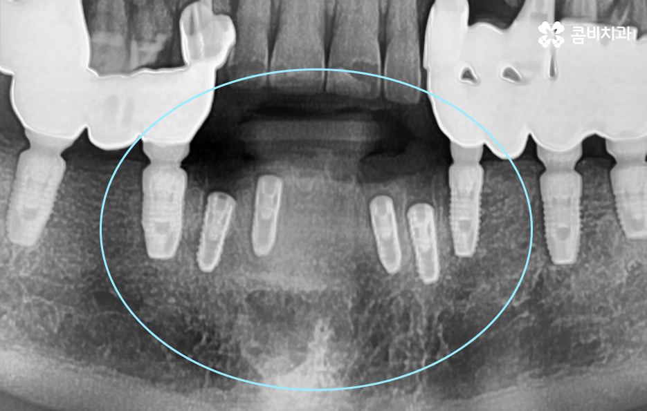 발치후 임플란트 기간 현실적으로 알아보면 관련 이미지 5