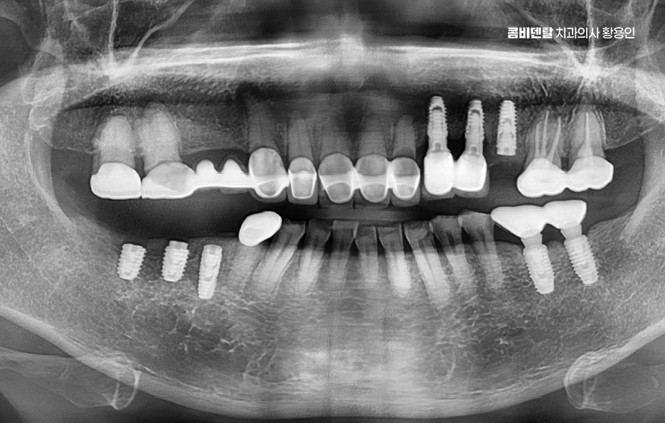 어금니 임플란트 안하면 후회하게 되는걸까 관련 이미지 4