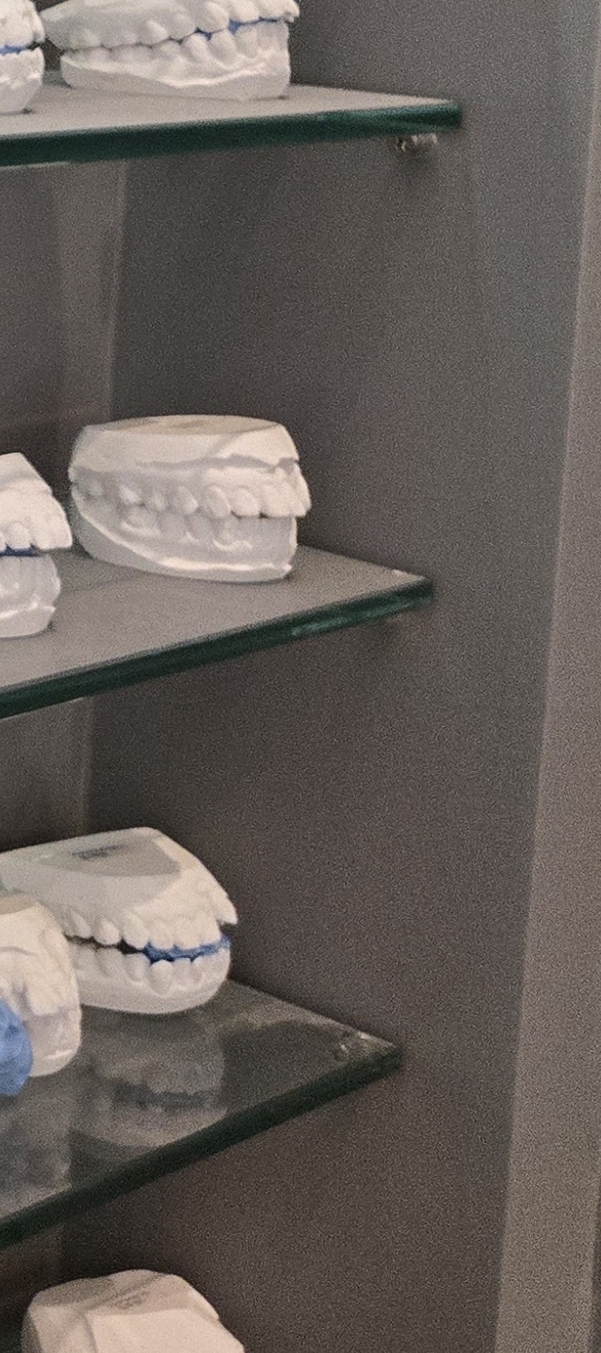 앞니 틀어짐 교정 이렇게 파악하세요 관련 이미지 21