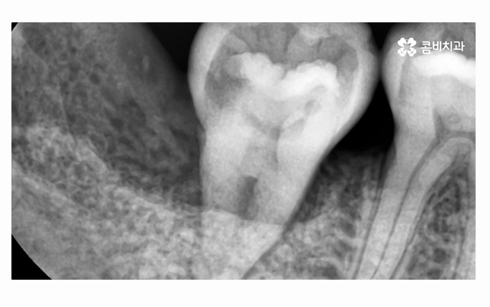 어금니 발치 심각해지기 전에 막으려면 관련 이미지 7