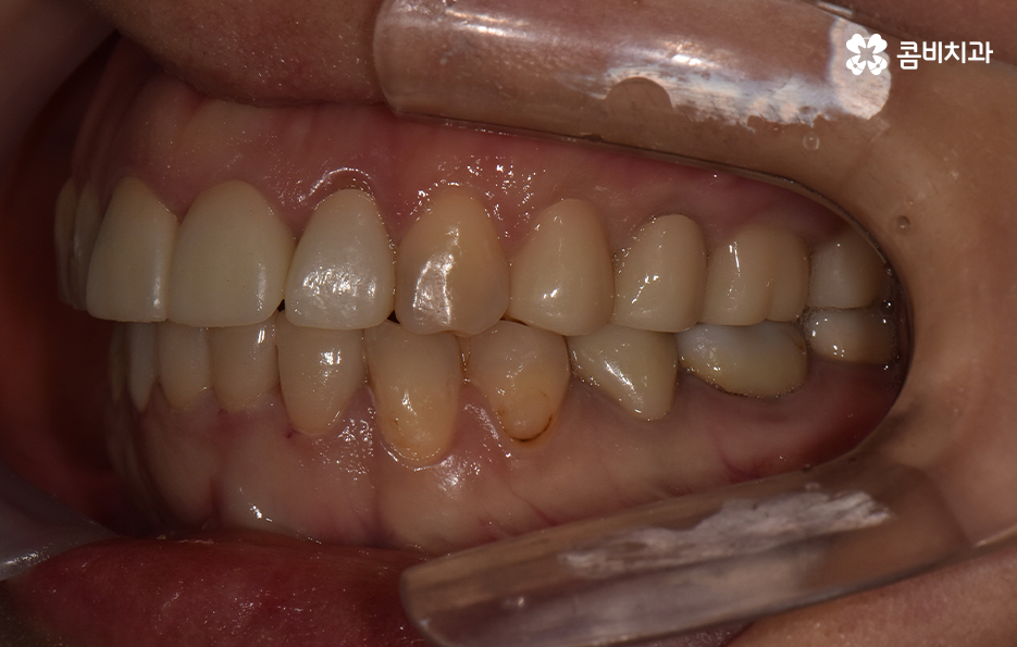 아래 앞니깨짐 치료 감쪽같이 해결하려면 관련 이미지 9
