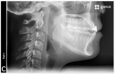 치아교정장치 어떻게 고르나요 관련 이미지 1