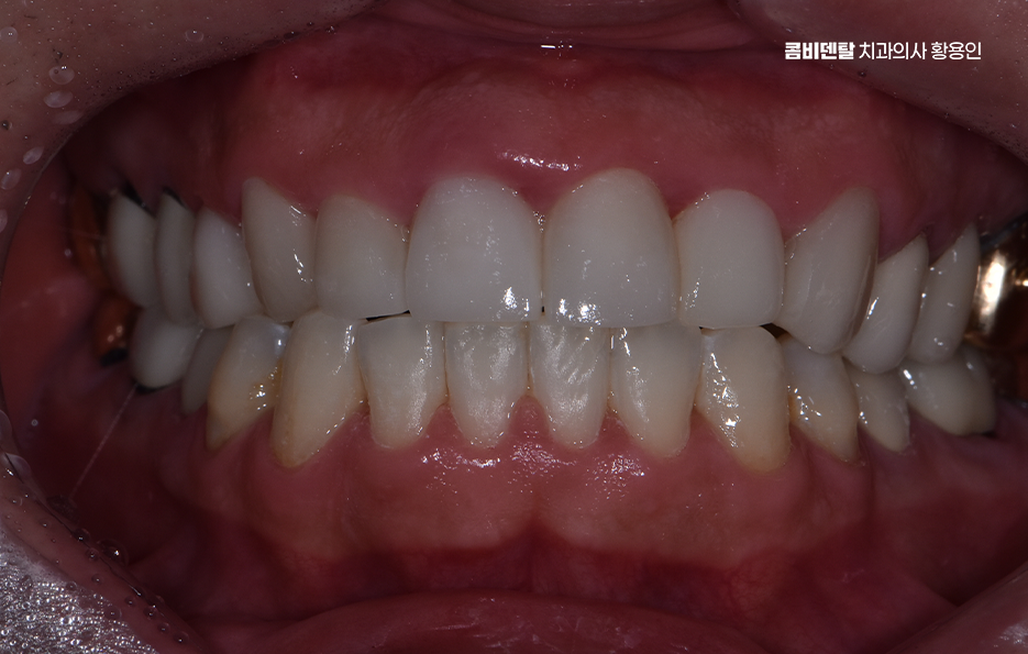 How to Use Laminate Veneers for Chipped Front Teeth image 4