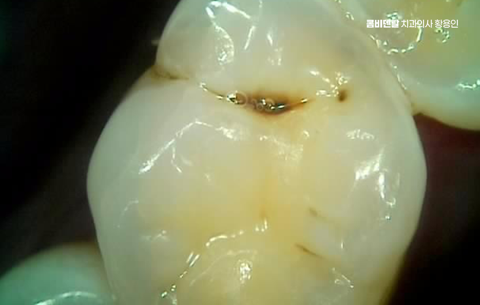 충치 검은점 나타났다면 이렇게 대처해요 관련 이미지 2