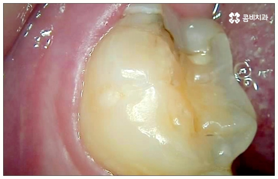 어금니 사이 충치 빠르게 대응해야 관련 이미지 2