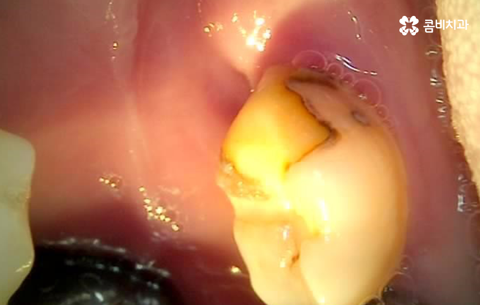 명동치과 놓치기 쉬운 2차충치에 주의하려면 관련 이미지 7