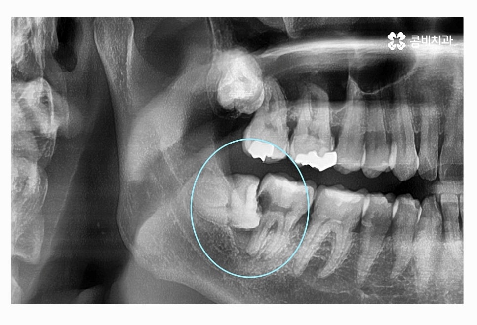 사랑니 충치 현명하게 접근하려면 관련 이미지 2