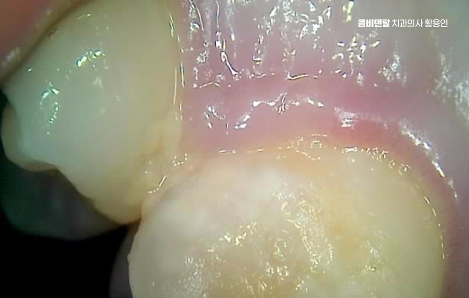어금니 뒤 잇몸 부음 어떤 문제길래 이런거죠 관련 이미지 4