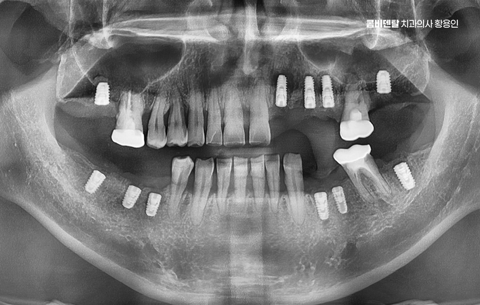 치아 발치 후 임플란트 언제부터 준비할까 관련 이미지 5
