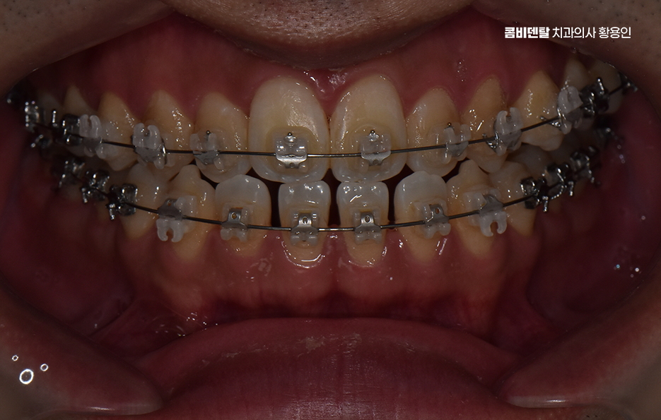 클리피씨교정 장단점 어떻게 비교하면 될까요 관련 이미지 4