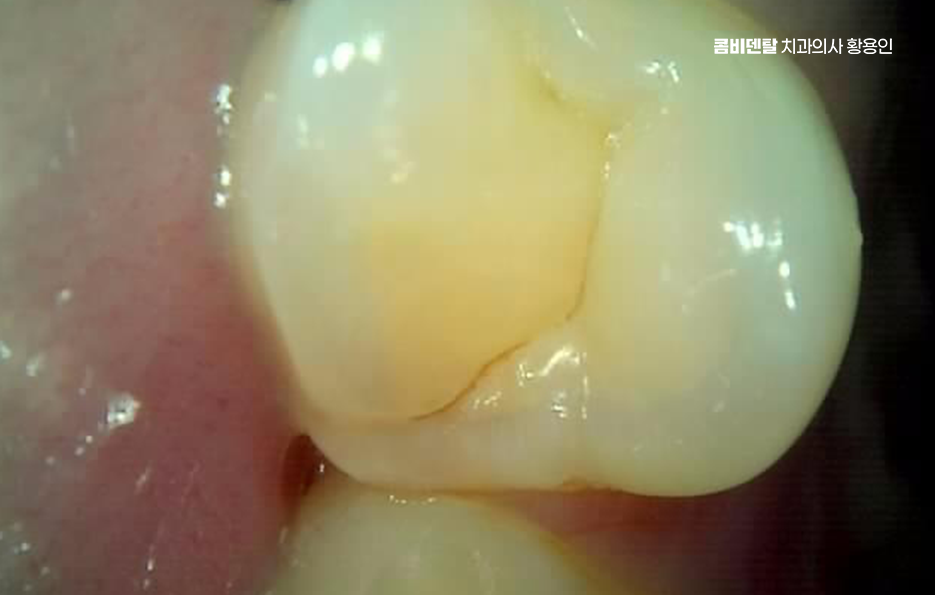 어금니 충치 단계 미리 알아차리려면 관련 이미지 4
