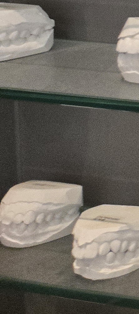 앞이빨 임플란트 과정 주의해야할 포인트는 관련 이미지 27