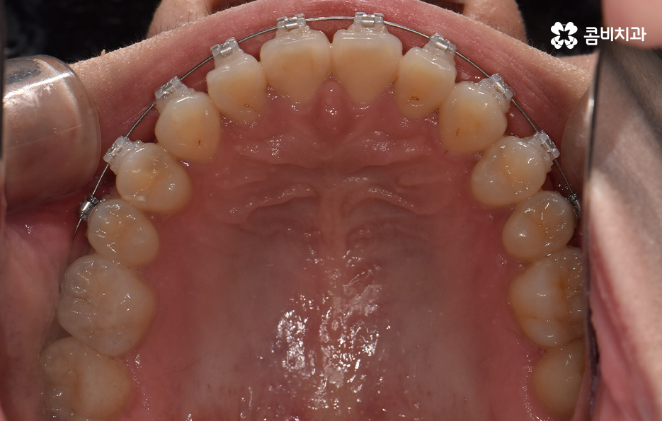 아래앞니 벌어짐 교정으로 해결했어요 관련 이미지 11