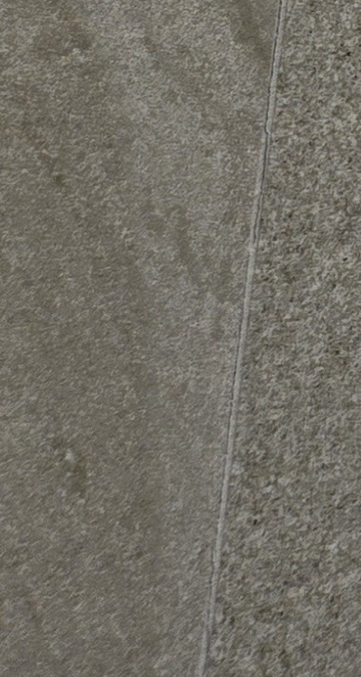 앞니 신경치료 크라운 까지 해야할 상황이라면 관련 이미지 42