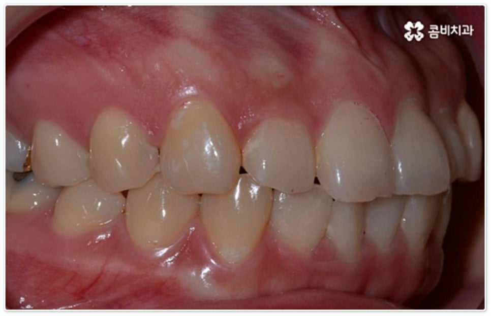 앞니부분교정 누구나 할수있나요? 관련 이미지 4