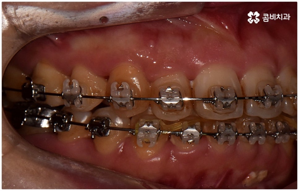 반대교합교정 늦지 않았어요 관련 이미지 13