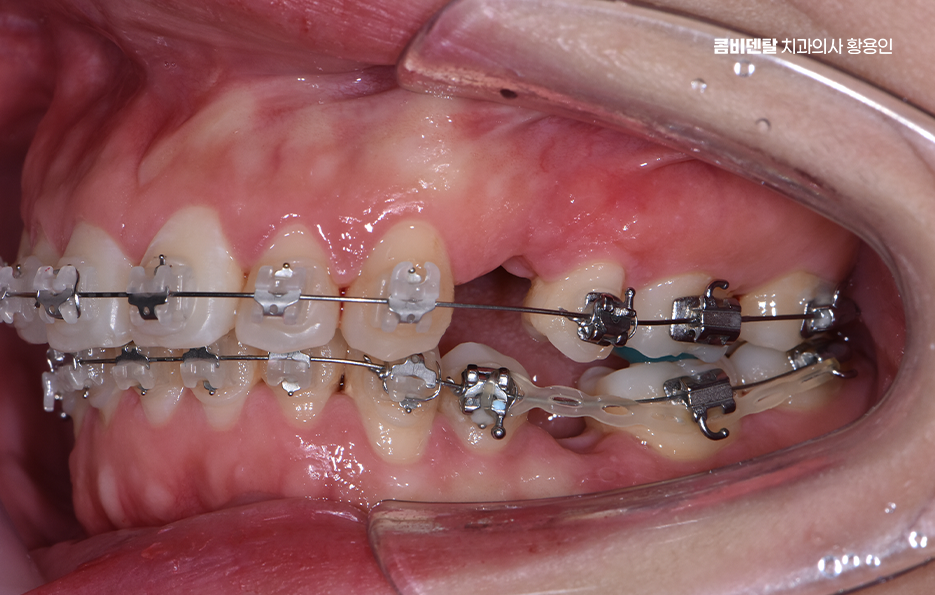 돌출입 팔자주름 교정 얼마나 바뀔까요 관련 이미지 8