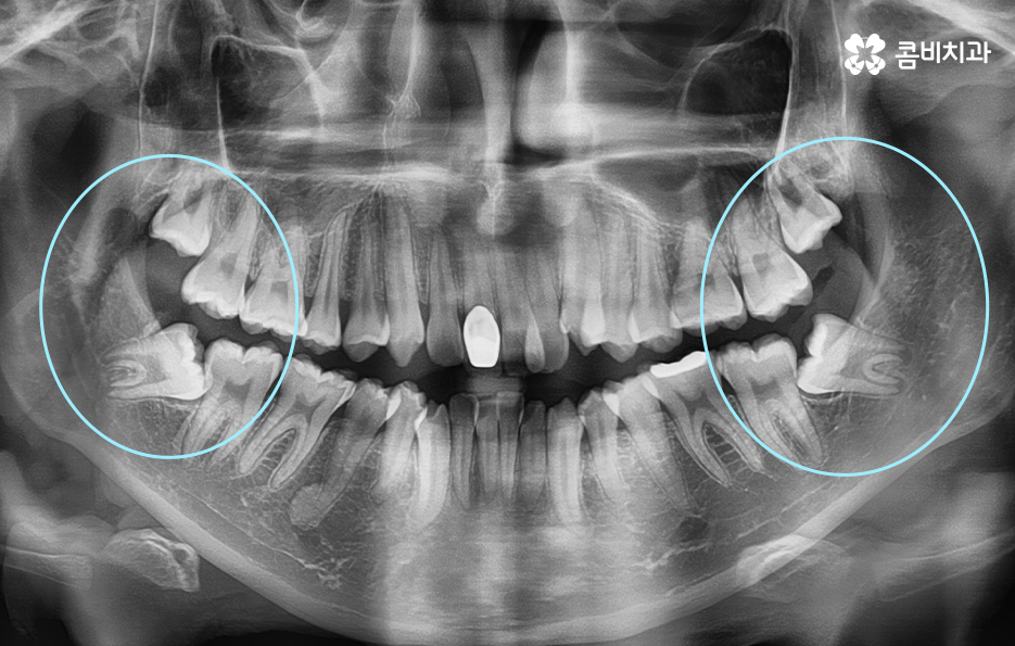덧니교정 불편함이 느껴지지 않더라도 관련 이미지 6