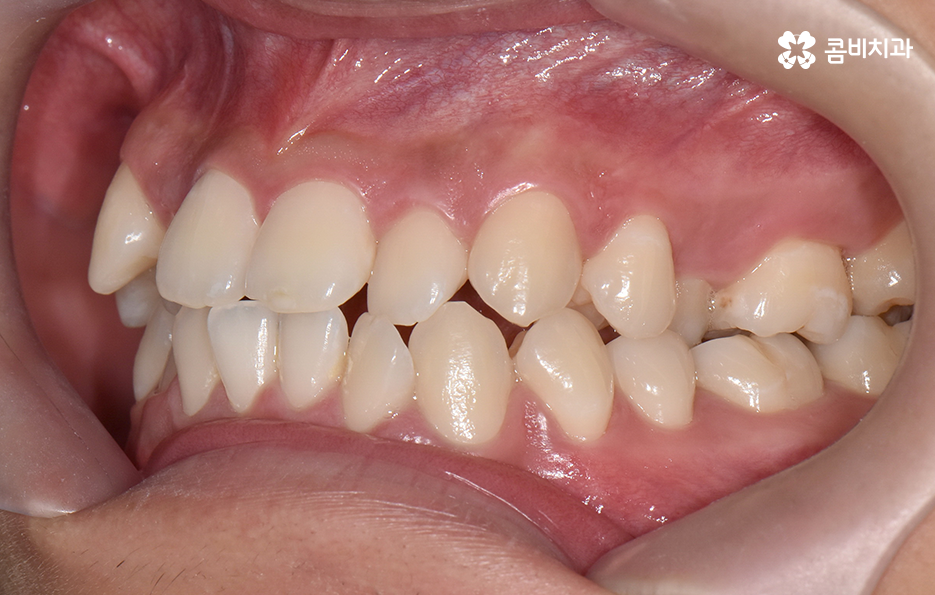 30대 치아교정 빨리 끝내고 싶어요 관련 이미지 3