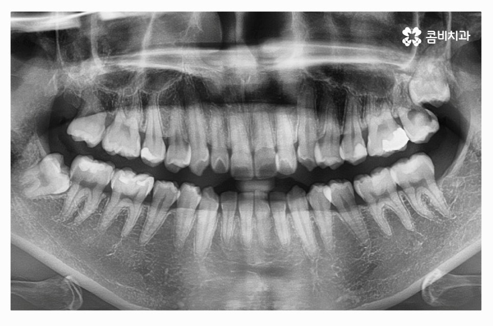 덧니교정 정교하게 따져보려면 관련 이미지 6
