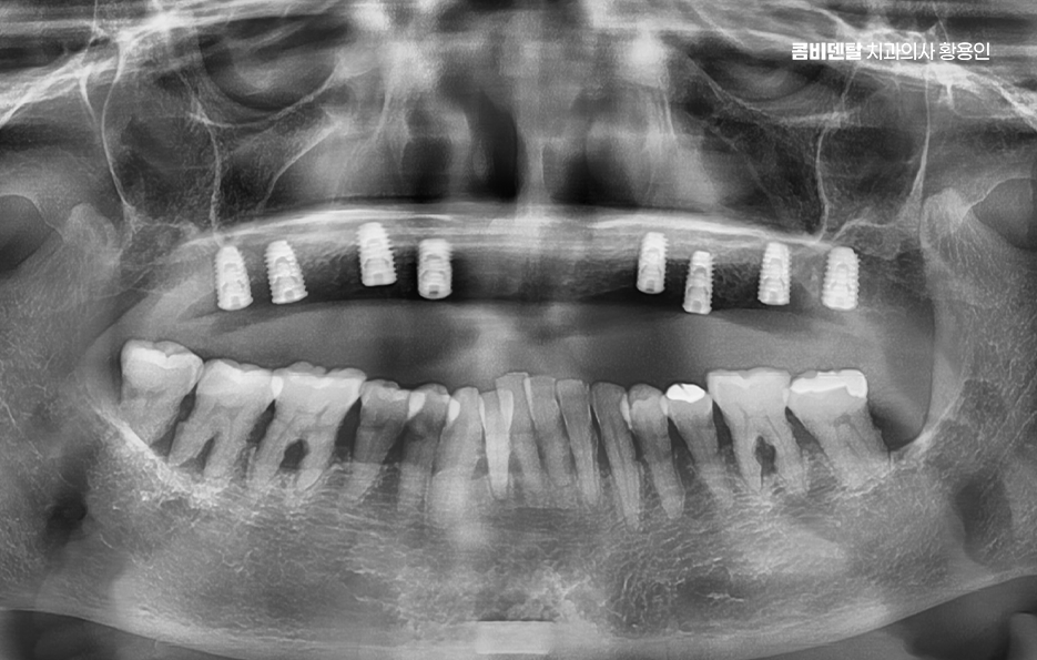 If You’re Considering Full Upper-Arch Implants for the Long Term image 5