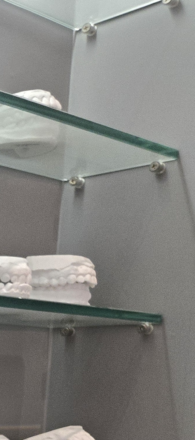 앞니 틀어짐 교정 이렇게 파악하세요 관련 이미지 15