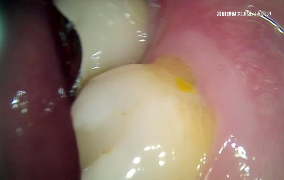 치경부마모증 치료 과정 신중하게 준비하려면 관련 이미지 4