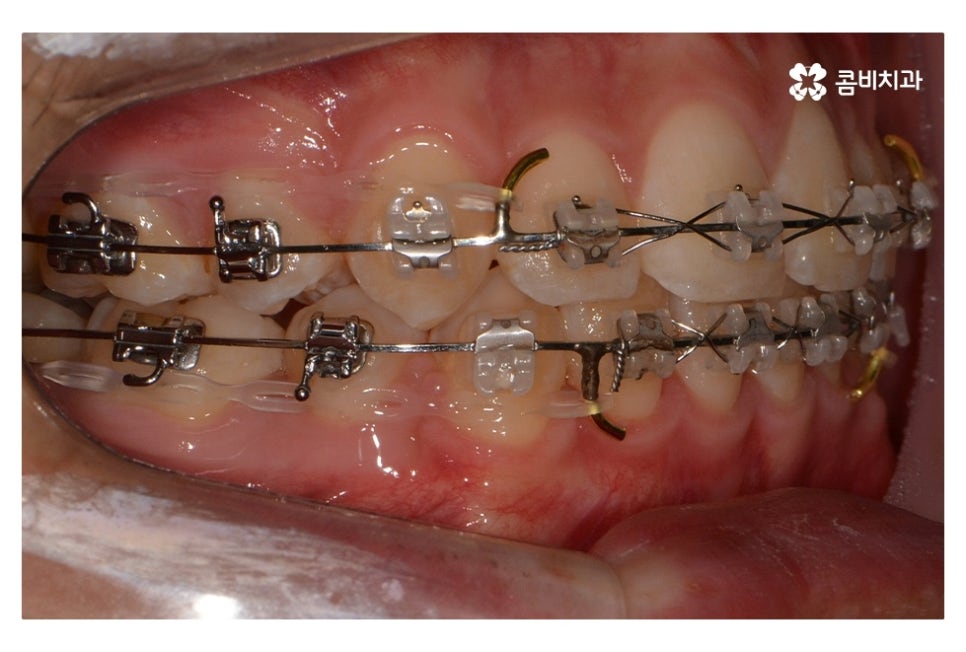 중학생치아교정 세심하게 체크하려면 관련 이미지 12