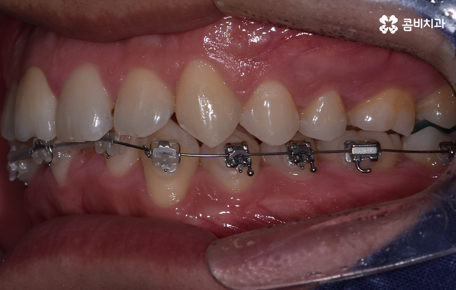 아랫니교정 이렇게만 파악하시면 됩니다 관련 이미지 9