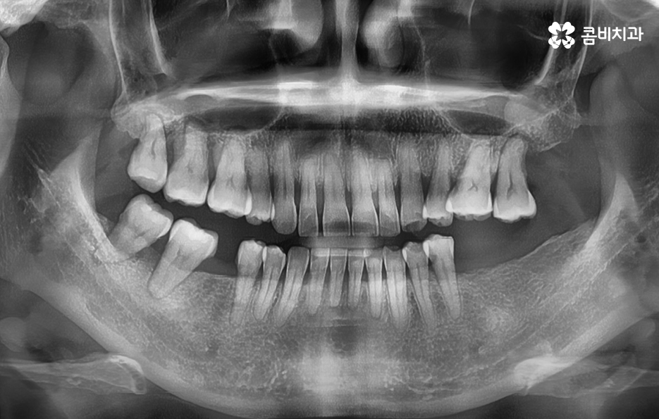 임플란트 해야 하는데 치아교정이 하고 싶다면 관련 이미지 1