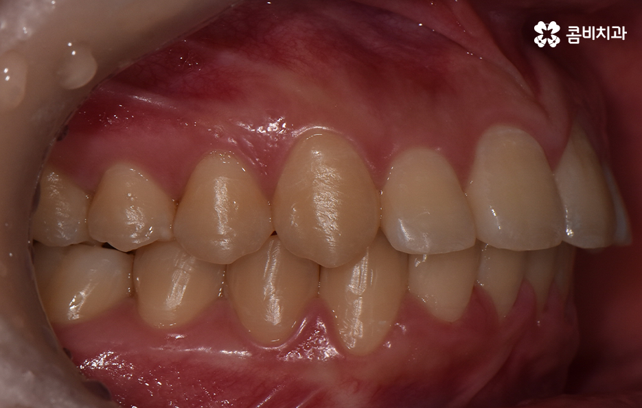 덧니 비발치 교정 자연스럽게 가능한 경우도 있어요 관련 이미지 8