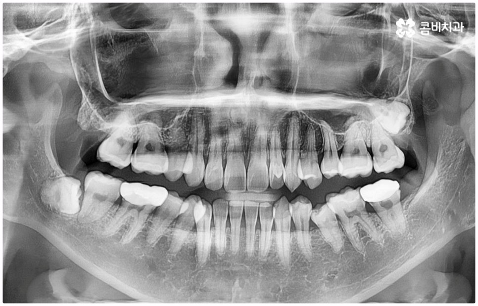 반대교합교정 늦지 않았어요 관련 이미지 1