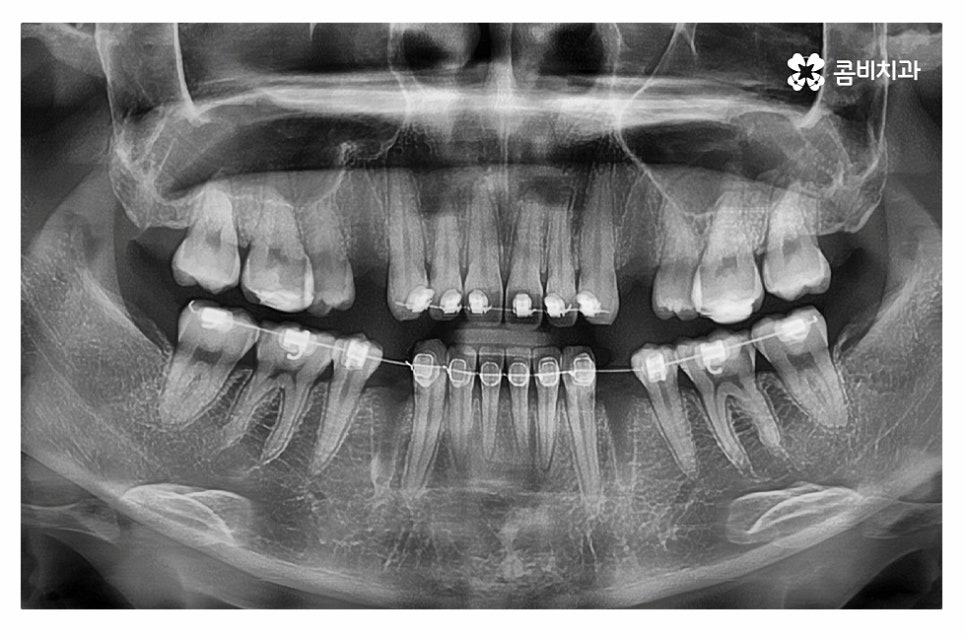 돌출입치아교정 적극적으로 해결하려면 관련 이미지 12