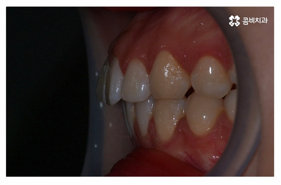 돌출입치아교정 적극적으로 해결하려면 관련 이미지 5